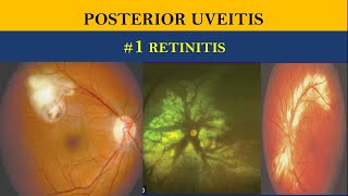 POSTERIOR UVEITIS  retinitis vs choroiditis [upl. by Masterson]