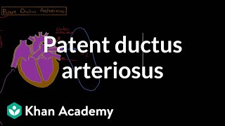 Patent ductus arteriosus  Circulatory System and Disease  NCLEXRN  Khan Academy [upl. by Eiramacissej274]