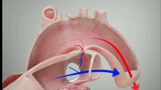 Patent Ductus arteriosus  PDA 3D Animation  YT Academy [upl. by Arel]