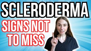 Signs Of Scleroderma NOT TO MISS [upl. by Michiko]