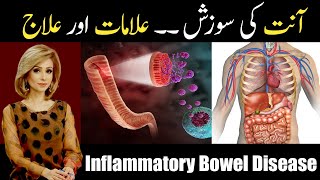 Inflammatory Bowel Disease IBD Causes and Treatment In UrduHindi [upl. by Eitteb]