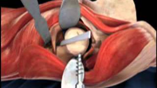 Femoral Head Osteotomy Animation  Direct Anterior Total Hip Replacement [upl. by Bijan]