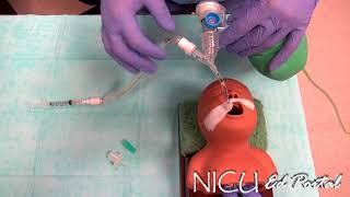 NICU Procedures Surfactant administration in a preterm infant [upl. by Lokim]