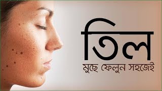 Til dur korer upay  চিরতরে মুখের ছোট ছোট কালো তিল দূর করবেন যে ভাবে। [upl. by Aisyram301]