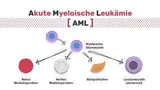 Akute myeloische Leukämie – Arten [upl. by Pero473]