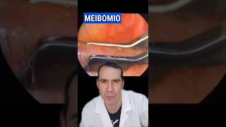 Disfuncion de la Glándula de MEIBOMIO oftalmologia glandulas meibomianglanddysfunction parpados [upl. by Ellehsor360]