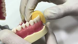 Anterior all ceramic crown preparation [upl. by Gagne34]