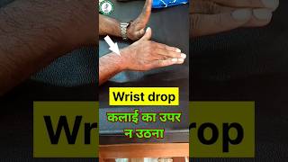 Wrist drop  Radical nerve palsy physio physiotherapy dr reels physio reels shortvideo [upl. by Aicatsana843]