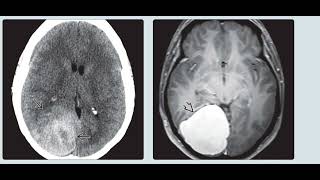 Aicardi syndrome brain imaging radiology cases [upl. by Chemush850]