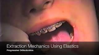 Extract Mechanics Using Elastics [upl. by Aneehsyt]