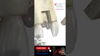 Bone graft and tooth implant medicalanimation dentist toothanatomy [upl. by Diraj252]