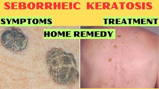 Understanding Seborrheic Keratosis Causes Symptoms Treatment Home Remedies [upl. by Aleibarg730]