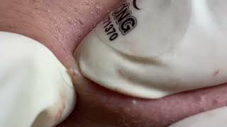 Acne Treatment Huong Da Nang  2024 blackheads 711 [upl. by Ohs]