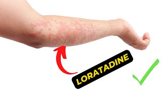 What is Loratadine Used For A Comprehensive Guide to Its Uses and Benefits [upl. by Kermit84]