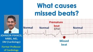 What causes missed beats [upl. by Gilletta247]