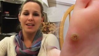 Wart Treatment  Wartrol Reviews  Wart Remover [upl. by Nolra]