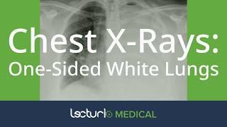 White Lung on Chest XRay Learn What It Means and How to Diagnose 🩺🖤 [upl. by Aztin]