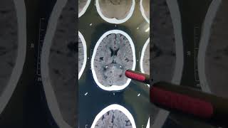 INTRACRANIAL CALCIFICATION doctor hospital  shorts video [upl. by Teyugn]