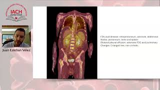 Elder Man with Perinephric Fibrosis [upl. by Nroht]