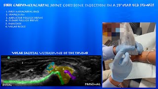 Ultrasound Guided Carpometacarpal Joint Injection in a 59 Year Old Female by probeultrasound [upl. by Edroi802]