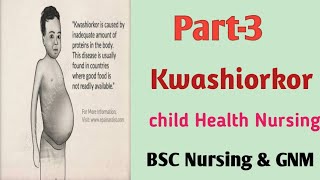 Kwashiorkor20 October 2020 [upl. by Tildy]