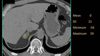 CT of Incidentalomas How We Manage Them Part 2 [upl. by Esille]