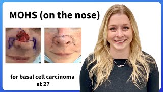 Basal Cell Carcinoma and MOHS on the nose at 27 in Boise 2021 [upl. by Flss702]