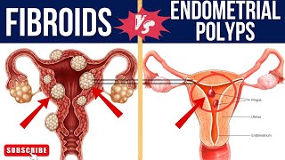 SIMILARITIES AND DIFFERENCES BETWEEN FIBROID AND ENDOMETRIAL POLYPSfibroid endometrium [upl. by Nohtiek]