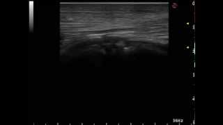 Lateral Patellar Ligament Tear in a Horse [upl. by Surbeck]