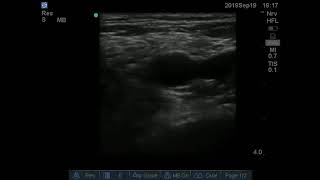 Ultrasound guided Obturator Nerve Block [upl. by Wheaton]