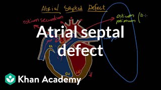 Atrial septal defect  Circulatory System and Disease  NCLEXRN  Khan Academy [upl. by Daugherty317]