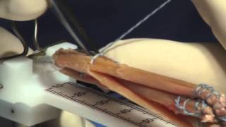 Hamstring Autograft Technique for ACL Reconstruction Surgery [upl. by Reifel]