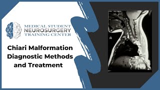 Chiari Malformation Diagnostic Methods and Treatment [upl. by Fesoj]