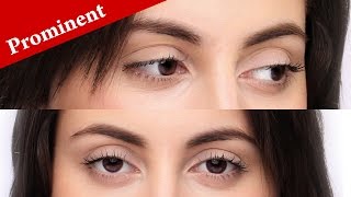 How to immediately know if your eyes are PROMINENT or PROTRUDING [upl. by Gnivri348]