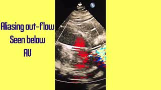 Impella Device TTE case of an Impella positional adjustment [upl. by Atilehs102]