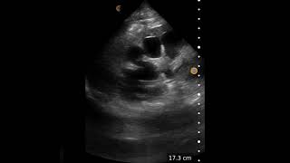 Severe Hydronephrosis  Ultrasound Image Interpretation [upl. by Cynar]