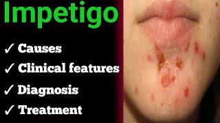 impetigo  causes  clinical features  diagnosis  treatment [upl. by Joya]