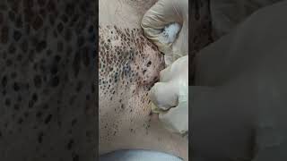 Nevus Comedonicus removal [upl. by Ras]