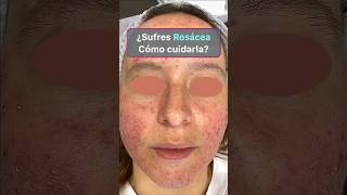 Los 4 mejores tratamientos de la rosácea rosacea rosaceaskincare [upl. by Nolos169]