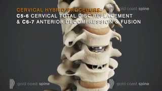 Cervical Hybrid – Cervical Spine Surgery [upl. by Yeleek532]