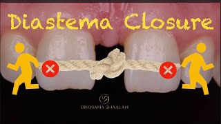 Diastema closure using direct bonding  front wing technique [upl. by Jaymee]