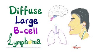 Diffuse Large BCell Lymphoma DLBCL  Aggressive BCell Neoplasm  NonHodgkin’s Lymphoma [upl. by Siurtemed]