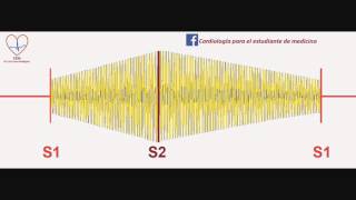 Soplo de la persistencia del conducto arterioso [upl. by Rosabelle64]