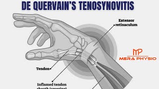 De Quervain’s Tenosynovitis  In Hindi  Mera Physio [upl. by Loredo387]