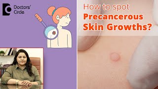 Skin Lesions and Cancer How to spot Precancerous Skin Growths DrTina RamachanderDoctors Circle [upl. by Russom]