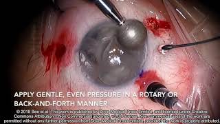 Band keratopathy removal without EDTA  Video S1  177636 [upl. by Holds]