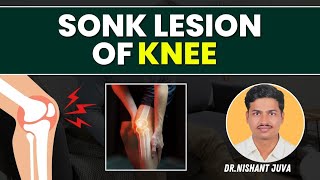 SONK lesion knee [upl. by Katie860]