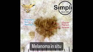 Melanoma in situ [upl. by Deina549]