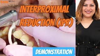 HowTo Perform Interproximal Reduction IPR for Orthodontic Treatment  a clinical demonstration [upl. by Yarehs27]