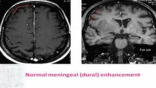 04 IBIC Supratentorial Extraaxial lesions Part02 [upl. by Jordanson]